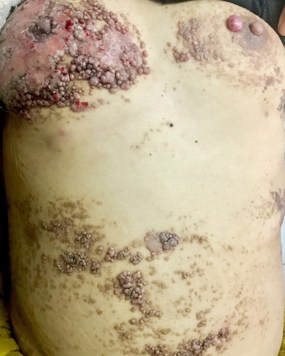 Figure 2: Discrete and confluent warty papules and plaques of various sizes on abdomen and breast area.