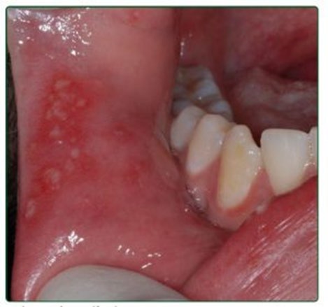 Figure 2: 1-2 mm spots.