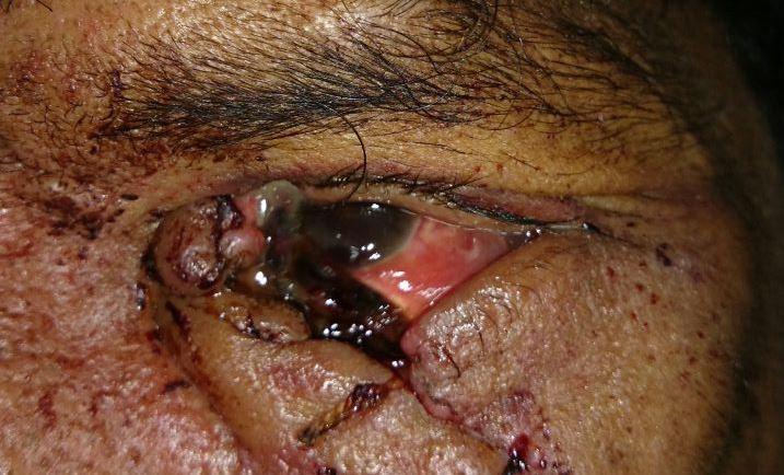 Figure 2: A patient with past history of RK with corneal rupture due to blunt trauma. Subsequently, corneal suturing was done.