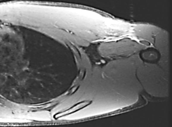 Figure 4: MRI showing hematoma and tissue edema at musculotendious junction of left pectoralis muscle.