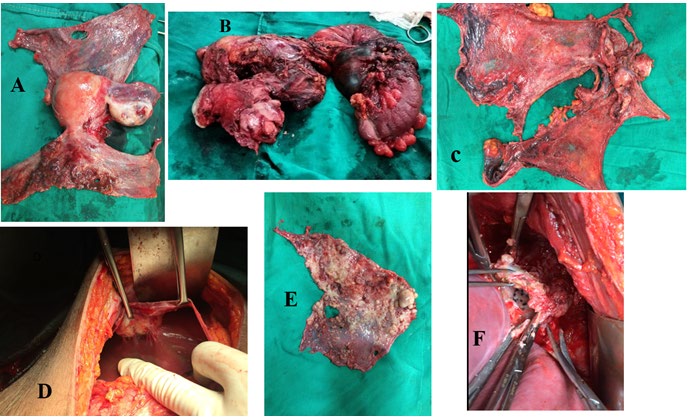 Figure 2: A= enbloc pelvic peritonectomy specimen with uterus and ovaries, B= Enbloc resection of uterus with ovarian tumor and recto-sigmoid in an ovarian cancer infiltrating recto-sigmoid mesentery, C= enbloc pelvic and abdominal peritonectomy, D= perihepatic deposit excision with diaphragm peritonectomy, E= diaphragm peritoneum stripped with tumor deposits, F= diaphragm central tendon excision with a deposit.