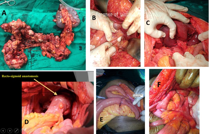 Figure 3: A= omental cake and splenectomy enbloc excision, B= foramen of Winslow and porta hepatis, C= porta hepatis deposit excision following cholecystectomy, D= Recto-sigmoid resection anastomosis, E= Small Bowel resection anastomosis, F= multiple bowel mesenteric tumor deposits.