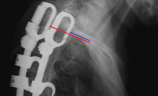 Figure 1: Measurement of the “translational distance” from the anterior rib cradle to the anterior vertebral body. When radiographic rotation led to different projections of the rib cradles (as seen here, red versus blue), the values were averaged.