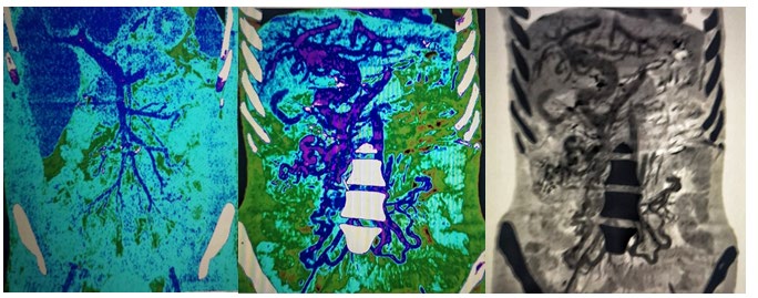 Figure 1: Abdominal entero-CT scan showing jejunal malposition with presence of a swirl like images at the right flank with a dilated mesenteric and parietal vein associated with collateral mesenteric venous circulation and tortuous dilated superior mesenteric vein of 18 mm.