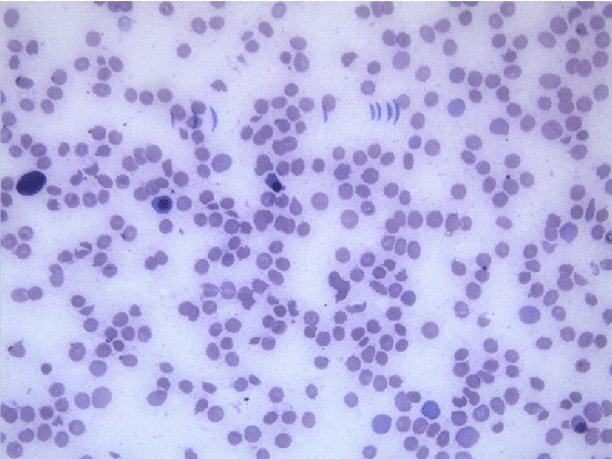 Figure 1: Peripheral smear showing Normoblasts (100 x).