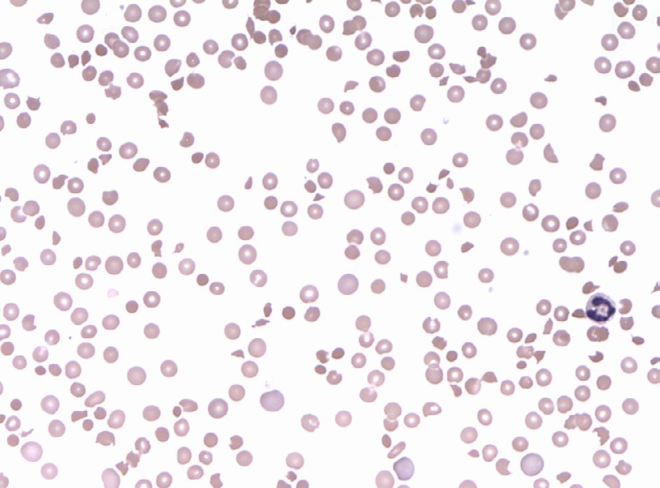 Figure 2: Peripheral smear showing schistocytes, polychromasia and thrombocytopenia (100 x).