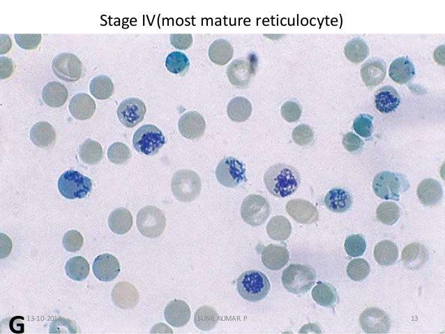 Figure 3: Peripheral smear showing Reticulocytes (100 x) Methylene Blue Stain