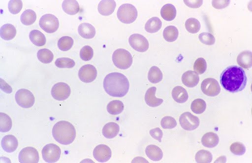 Figure 4: Peripheral smear showing macrocytic normochromic anemia along with polychromatophilic cells.