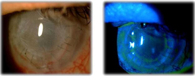 Figure 4: Slit-lamp images of the left eye (case 2) with amniotic membrane graft and contact lens (A) and six weeks (B) after treatment with Cacicol20.