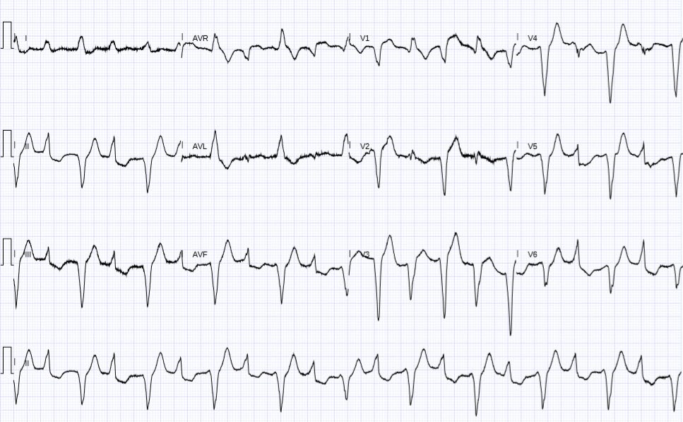 Figure 1: ECG Graphic Evidence of bifascicular ventricular tachycardia.