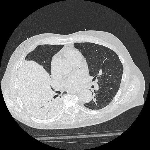 Figure 2: Evidence at HRTC parenchymal consolidation with morphological characteristics of the atelectasis type at the level of the lower right lobe.