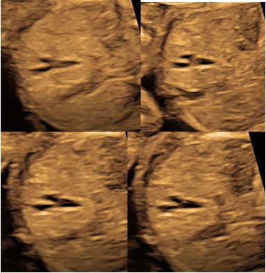 Figure 2: Two ﬂuid-filled; parallel double tubular structures with anterior blind ending with sludge in the right upper quadrant of the liver; Duplicated Gall Bladder (Bodyen’s – Y shaped gall bladder) in Twin I.