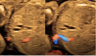 Figure 3: Duplicated Gall bladder with curved umbilical vein in the midline with sludge in 3A; differential persistent right umbilical vein.