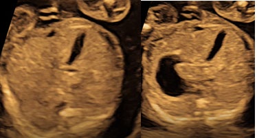 Figure 4: Single saccular fluid filled nonvascular structure in the right upper quadrant of liver suggestive of normal gall bladder in Twin II.