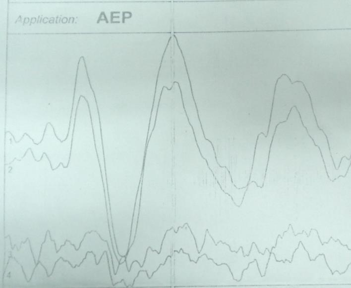 Figure 1: Arrow Pointing To The Elevated Amplitude at Low Threshold In Vemp.