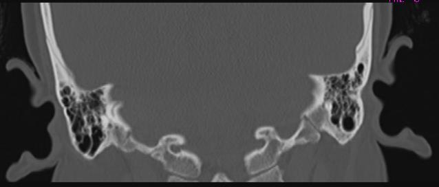 Figure 2: HRCT Temporal Bone, Coronal and Axial Scans Illustrating Dehiscence of the Right Posterior Semicircular Canal at Its Dome. The Bony Dehiscence Is Seen Extending Anteriorly till the common crus with the superior semicircular canal.