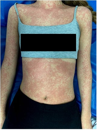 Figure 1: Erythematous maculopapular rash.