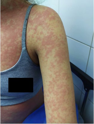 Figure 2: Erythematous maculopapular rash.