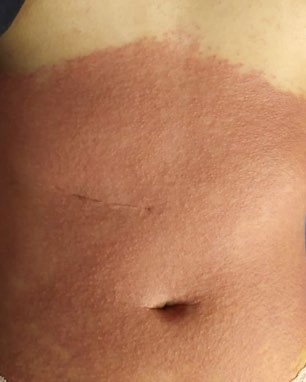Figure 3: Confluent erythematous maculopapular rash.