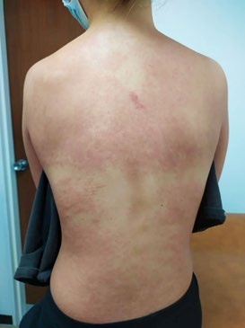 Figure 6: Bipalpebral edema.