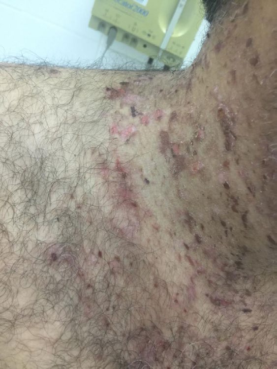 Figure 1: A close-up perspective on the patient’s skin lesions. As his condition is severely pruritic, note that the illustrated skin lesions are sites of previously intact bullae and vesicles.