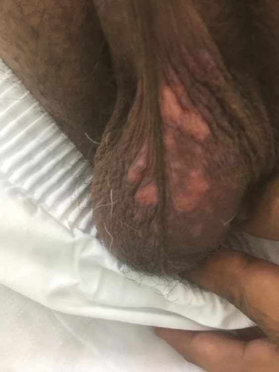 Figure 2: Scrotal involvement.
