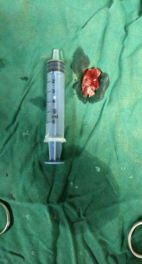 Figure 3: Post-operative lesion.