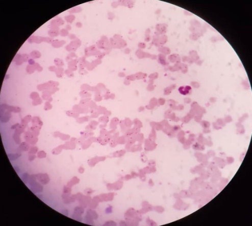 Figure 2: Thin film using Giemsa stain under the microscope.