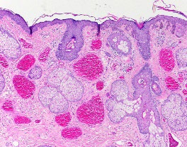 Figure 1: Port wine stain with vascular dilatation, red cell extravasation, cutaneous adnexal structures and a superimposed acanthotic epithelium [9].