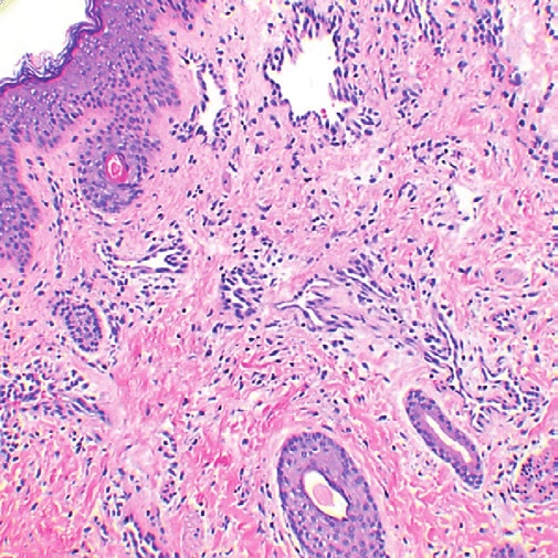 Figure 2: Capillary malformation with vascular distension, encompassing, mildly inflamed fibrous tissue stroma and acanthosis of the superimposed epithelium [10].
