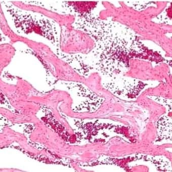 Figure 3: Cavernous haemangioma with enlarged vascular spaces lined with flattened endothelium, red cell aggregation and an intervening, mildly inflamed fibrous tissue stroma [11].