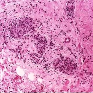Figure 4: Tufted angioma with vascular spaces lined by plump endothelium with projections, partially solid vascular configurations and an encompassing, inflamed fibrous tissue stroma [12].