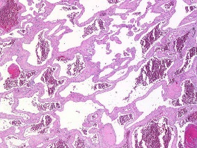 Figure 6: Cavernous haemangioma with enlarged, patent vascular configurations, red cell extravasation and a mildly inflamed, intervening fibrotic stroma [14].