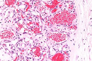 Figure 9: Haemangioma with dilated vascular configurations impacted with red cells and an intermingled, inflamed fibrous tissue stroma [17].