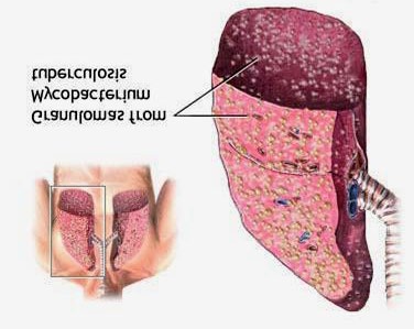Figure 2: Latent Tuberculosis Infection (LTBI) (56).
