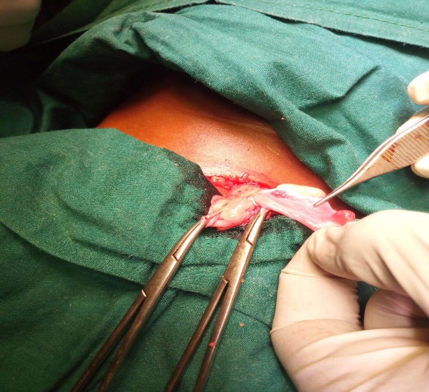 Figure 1: Intra operative picture of 1st patient showing ovary and part of uterus in the hernial sac.