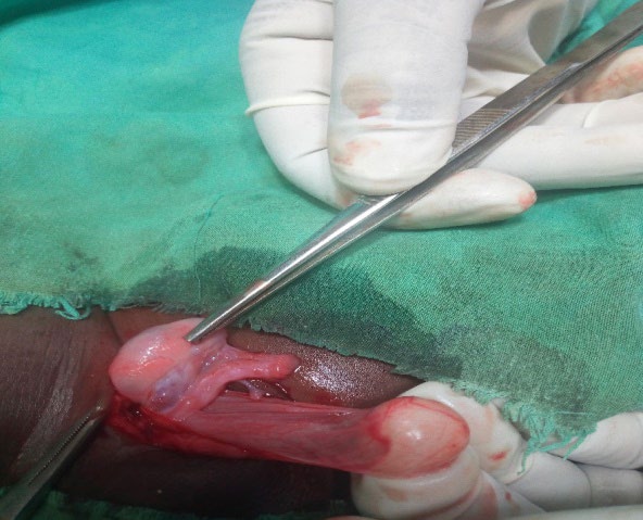 Figure 2: Intra operative picture of the second patient showing the ovaries and part of fallopian tube Patient did well post operatively, was seen a week after the operation and is still on followed up in the surgical out- patients’ clinic.