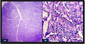 Figure 1: a) Excision biopsy of the left supraclavicular mass showing metastatic adenocarcinoma of undetermined origin (H & E, x10). b) Tumor composed of malignant cells with vesicular nuclei and prominent nucleoli (H & E, x40).