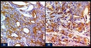 Figure 2: a. Immunohistochemical staining of the neoplastic cells, exhibiting strong positivity for PSA (IHC, x40). b. AMACR positivity of the tumor cells (IHC, x40).