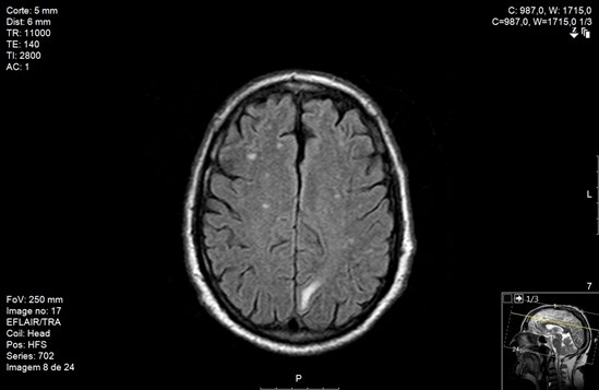 Figure 1: MRI revealing multiple small nodular contrast-enhanced lesions with vasogenic edema in both frontal and parietal cortex, and left temporalis.