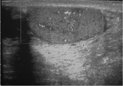 Figure 1: Right testicle.