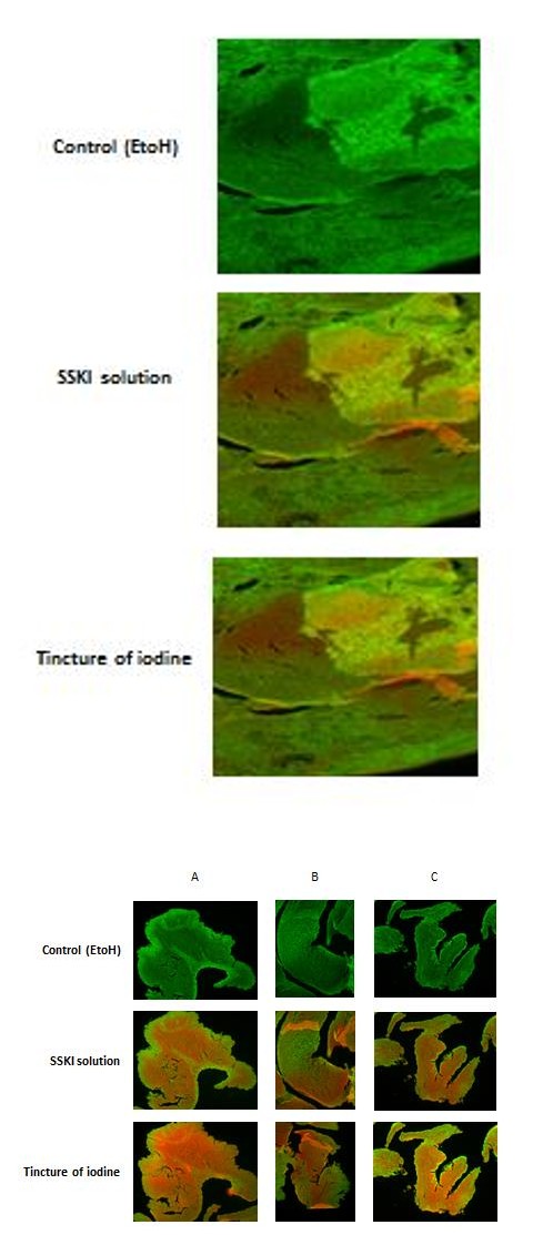 Figure 1: The patient specimens were treated with tincture of iodine and potassium iodide for 10 minutes. The Baclight assay was done to quantitate the live and dead cells. The red color represents damaged membranes (dead cells) and the green color shows intact cell membranes (live cells). The control image was taken at 635 nm to get the total intact cell membranes.