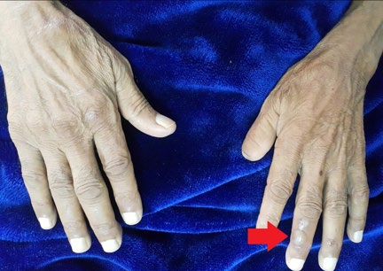 Figure 2: Showing _Bullous Diabeticorum_ on dorsal aspect of fingers of hand.