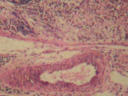 Figure 3: Group-B-Diabetic control rats showing damaged beta cells.