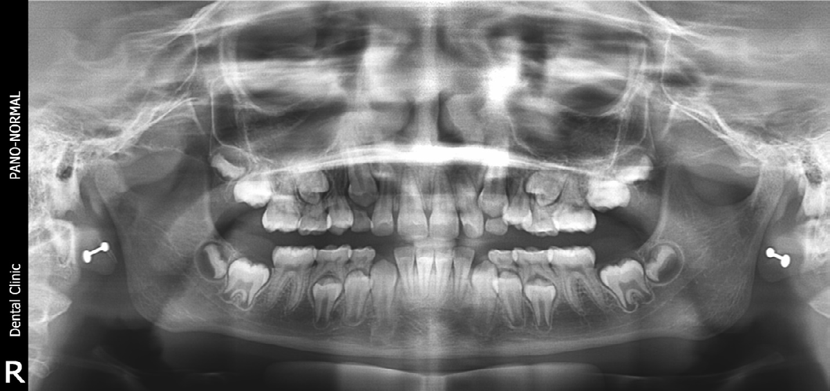 Figure 1: Orthopantomograph showing apical foramen open.