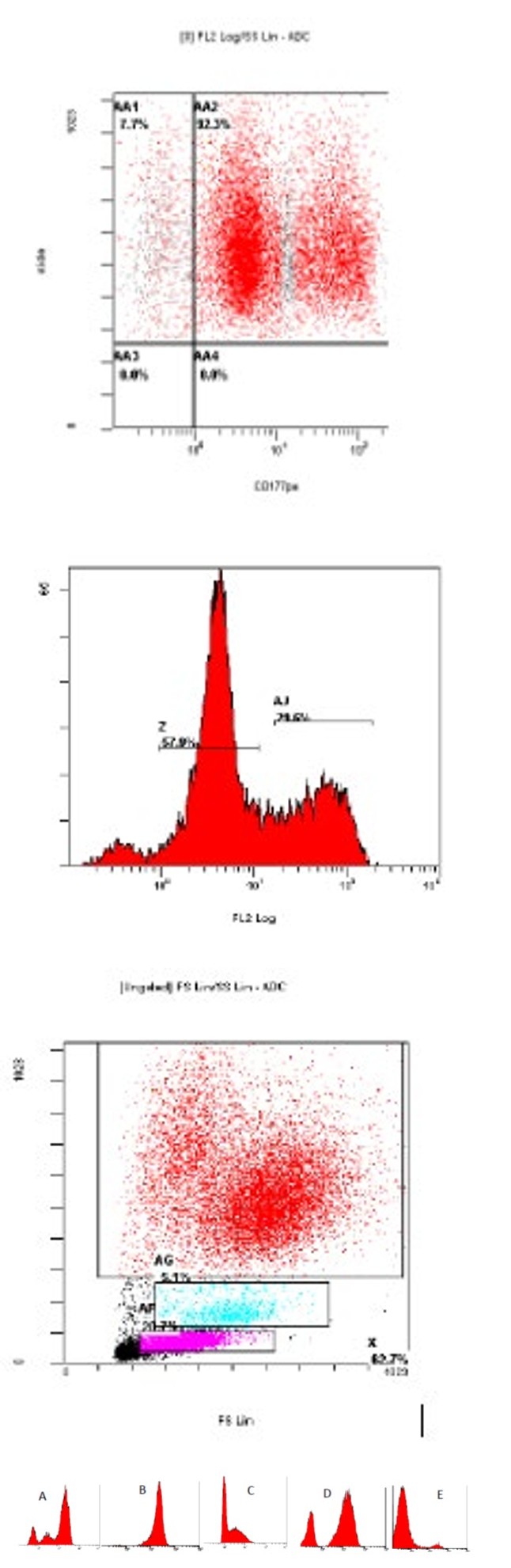 Figure 1: Patterns of peripheral blood neutrophil CD177+ve cells expression observed in flow cytometry. A) Bimodal pattern detected in the study. B) CD177 single bright positive peak C) CD177 single dim positive peak. D) A high percentage of CD177 positive cells. E) A low percentage of CD177 positive cells.