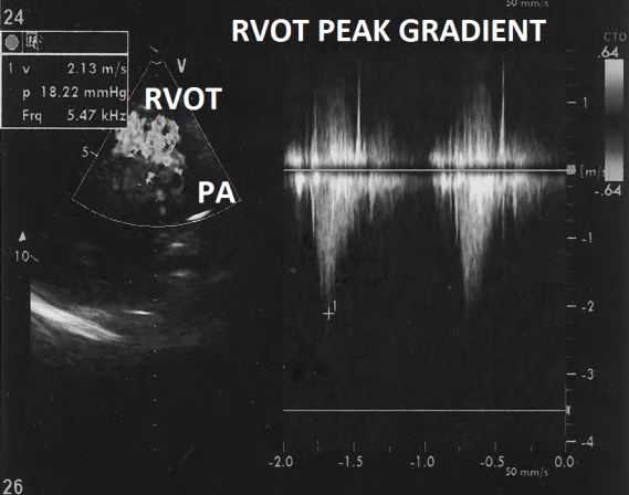Figure 11: Doppler evaluation showing right ventricular outflow tract peak systolic gradient of 18.2 mm Hg.