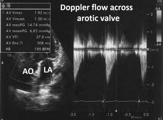 Figure 18: Showing normal Doppler flow across aortic valve.