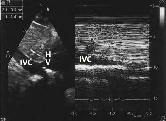 Figure 2: Subcostal long axis view showing normal dimension and normal inspiratory collapse of inferior venacava (IVC).