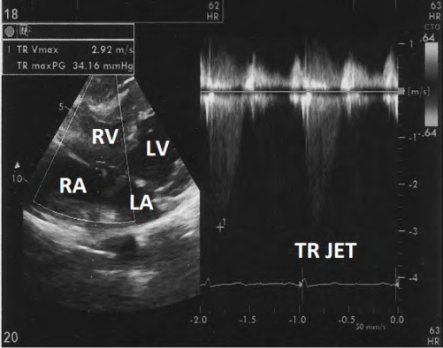 Figure 5: Showing Doppler evaluation tricuspid regurgitation Jet.